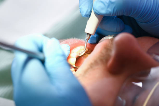 Best Emergency Dental Extractions in Mars Hill, NC