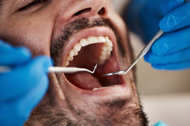 Best Emergency Dentist for Lost Fillings or Crowns in Mars Hill, NC